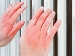 Image result for Chilblains