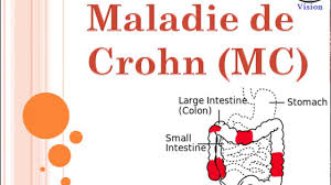 La maladie de crohn c'est quoi. Maladie De Crohn Crohn Disease Symptomes Diagnostic Youtube