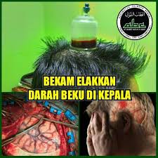 Waktu ibu saya berantem sama tetengga saya , ibu saya. Elakkan Darah Beku Di Kepala Al Hadid Bekam Centre Facebook
