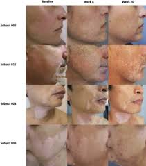 Image result for robert zaruba vitiligo