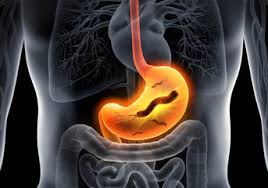 American college of gastroenterology guideline on the management of helicobacter pylori infection. InfecÈia Cu Helicobacter Pylori Cauze Simptome Tratament Newsmed Ro