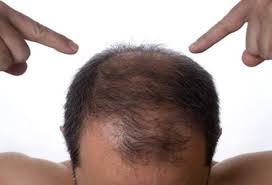 Your family history is the biggest predictor of thinning hair, especially typical male pattern baldness. Hair Loss Causes Treatments And Prevention