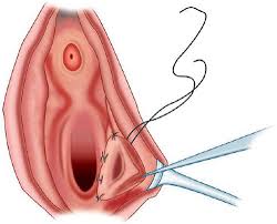 Image result for Bartholin's gland abscess