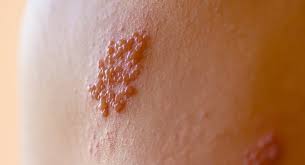 Hsl (hue, saturation, lightness) and hsv (hue, saturation, value, also known as hsb or hue, saturation, brightness) are alternative representations of the rgb color model. Herpes All You Need To Know About This Viral Infection