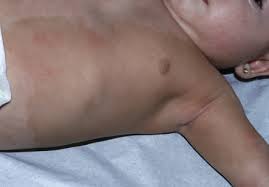 Image result for Diffuse Hyperpigmentation