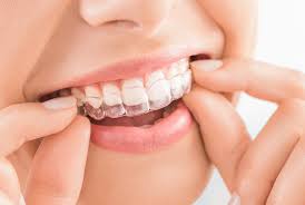 Too Old for Invisalign? It's Never Too Late to Straighten Your Smile