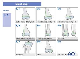 Image result for Fracture Types