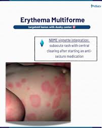 Image result for Erythema Multiforme