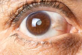 Image result for Glaucoma