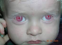 The Most Definitive Feature Of Albinos Red Eyes Albino Human Albino Albinism