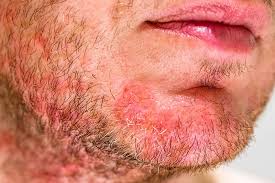 Image result for demodex rosacea