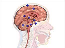 Brain tumors often cause personality changes and sudden mood swings. Secondary Brain Cancer
