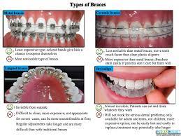 Four Types Of Braces Types Of Braces Dental Braces Braces
