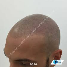 Dell'intervento di tatuaggio capelli e più probabile sarà . Tricopigmentazione Permanente Cos E E Come Funziona Consulto Gratis