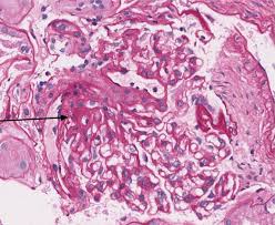 Chronic Kidney Disease News Treatment Studies Ckd Clinical Research