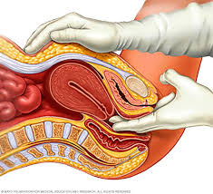 See the picture below which illustrates the procedures that surgeons will carry out to determine the by understanding the different stages of ovarian cancer patients can become involved in making informed decisions about. Ovarian Cancer Diagnosis And Treatment Mayo Clinic