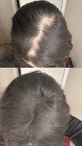 Hair Fill-Up Before and After