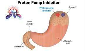 Proton pump inhibitors (ppis) are medicines that work by reducing the amount of stomach acid made by glands in the lining of your stomach. With H Pylori High Dose Of Ppis Tied To Gastric Intestinal Metaplasia And Cancer Study