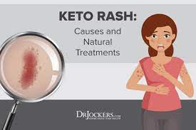 Keto Rash Causes And Natural Treatments Keto Rash Keto Rashes Remedies