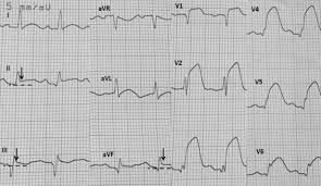 Image result for Early Repolarization
