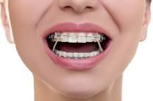 Image result for what stage of ortho treatment are interarch rubber bands used