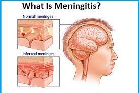 Pneumococcal meningitis is a type of bacterial meningitis, a serious infection of the meninges, membranes that surround the brain and spinal cord. Pneumococcal Meningitis The St Thomas Hospital Malta Facebook
