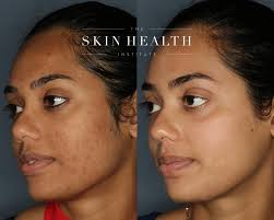 It's the skin for us 😍 . We're mesmerised by these game changing results  our patient enjoyed by undergoing a bespoke ZO SkinHealth Acne protocol .  Enjoy your very own Rx protocol,