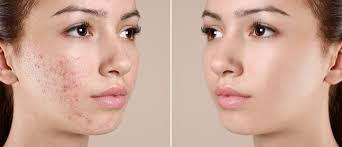Image result for acne face