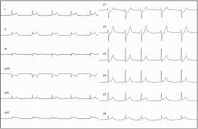 Myocarditis is the term used to describe the acute infective, autoimmune, or toxic inflammation of the heart muscle, which is also known as myocardium. Miocarditis Extensa Sociedad Espanola De Cardiologia