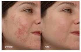 What are the uses of Niacinamide in a face serum? - Indrani Cosmetics