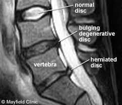 Herniated Disc Herniated Lumbar Disc Hld Bulging Disc Mri Herniated