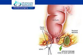 What To Do If A Perianal Abscess Bursts Can You Pop A Perianal Abscess