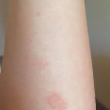 Hautpilz Der Nicht Juckt Pickel Flecken Infektion