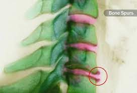We did not find results for: What Is Spondylosis Causes Symptoms Treatment Surgery