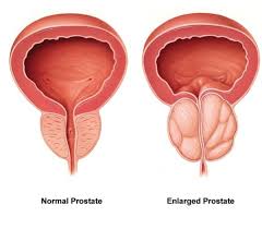 The symptoms of benign prostatic hyperplasia or of other problems in the prostate may be like symptoms of prostate cancer. Signs Of Prostate Cancer In Dogs Dog Discoveries