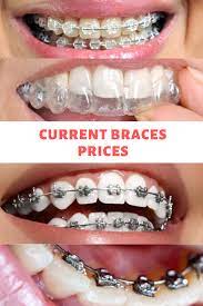 Current Braces Prices Braces Price Dental Braces Braces Treatment