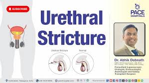 Image result for Urethral Stricture