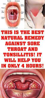 This Is The Best Natural Remedy Against Sore Throat And Tonsillitis It Will Help You In Only 4 Hours Sore Throat Tonsilitis Remedy Best Sore Throat Remedies