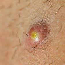 Maybe you would like to learn more about one of these? The Doctor S Way Of Treating A Boil Yourself Health24