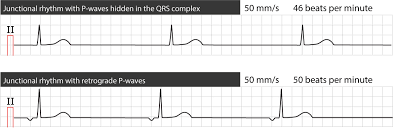 The junctional rhythm initiates within the av nodal tissue. Junctional Rhythm Escape Rhythm And Junctional Tachycardia Ecg Echo
