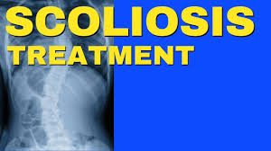 What Is Scoliosis And Scoliosis Treatment Without Surgery Dr Walter Salubro Chiropractor In Vaughan Youtube
