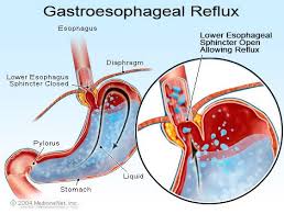 The time tested definitive treatment for persistent acid reflux is fundoplication. Acid Reflux Symptoms Remedies Causes Diet Treatment Foods To Avoid