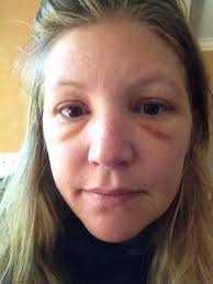 My Experience of a Bee Sting Near My Eye (With Photo Progression)