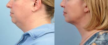 Embracerf combines two clinically proven technologies to produce dramatic improvements in skin laxity. Facetite Charleston Non Surgical Skin Tightening Dr David Rodwell
