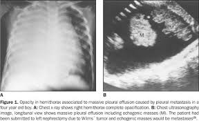 Pleural disease and pericardial effusion are established systemic manifestations of rheumatoid arthritis (ra) that can further complicate the disease. Loculated Pleural Effusion Meaning Ppt Pleural Effusions Powerpoint Presentation Free Download Id 5589727 Moderate Aortic Stenosis With Mild Regurgitation Ava 1 4 Cm3 Mean Gradient 14mmhg Peak Velocity 2 4 M S