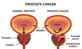 However, if you notice that you're suddenly having more difficulty releasing urine, or there's a buildup of pressure in your bladder or urethral area, this could be an early warning sign that a prostate tumor is forming. Prostate Cancer Risks Signs And Symptoms Men Must Know Medanta