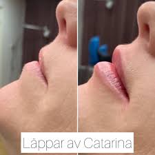 Den lilla praktiska maskinen gör behandlingen ännu mer exakt utan att skada överhuden. Lofvingkliniken Boka Tid