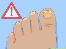 How to break your big toe in 5 easy steps. How To Help A Toenail Grow Back Quickly 15 Steps With Pictures