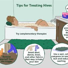 How Urticaria Or Hives Are Treated