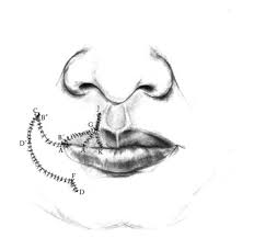 Find fujica flap gate to change the way you keep your building secure. References In Yu S Flap For Lower Lip And Reverse Yu S Flap For Upper Lip Reconstruction 20 Years Experience British Journal Of Oral And Maxillofacial Surgery